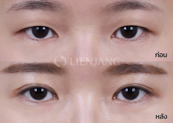 Incisional double eyelid · 1 month after surgery — Lienjang case #027