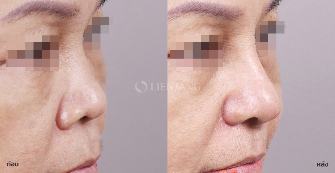 Rhinoplasty: bridge + tip · 6 months after surgery — Lienjang case #090