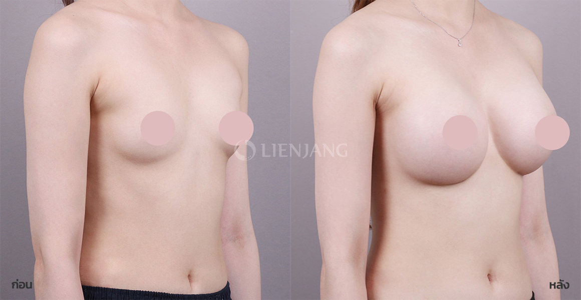 Breast augmentation (smooth implant) · 3 months after surgery — Lienjang case #154