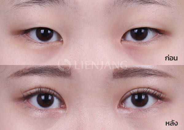 Epicanthoplasty + Incisional double eyelid · 6 months after surgery — Lienjang case #028