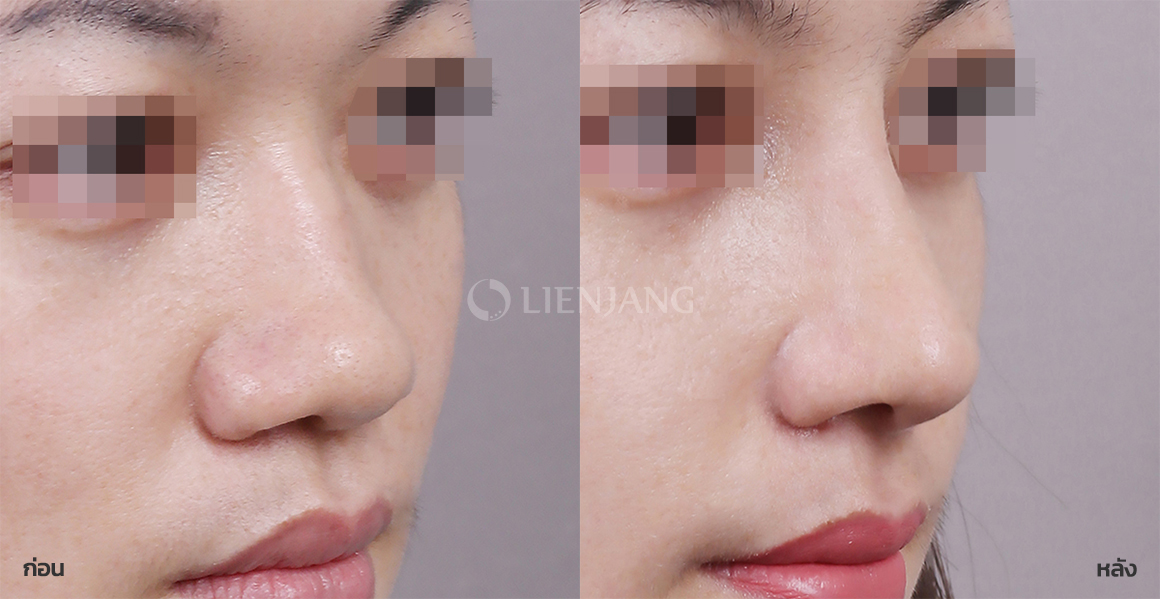 Rhinoplasty: bridge + tip · 6 months after surgery — Lienjang case #091