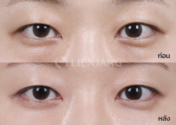 Under-eye fat repositioning · 1 month after surgery — Lienjang case #029