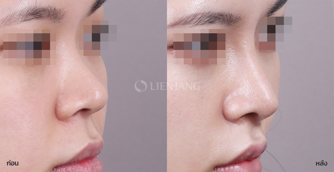 Rhinoplasty: bridge + tip · 3 months after surgery — Lienjang case #092