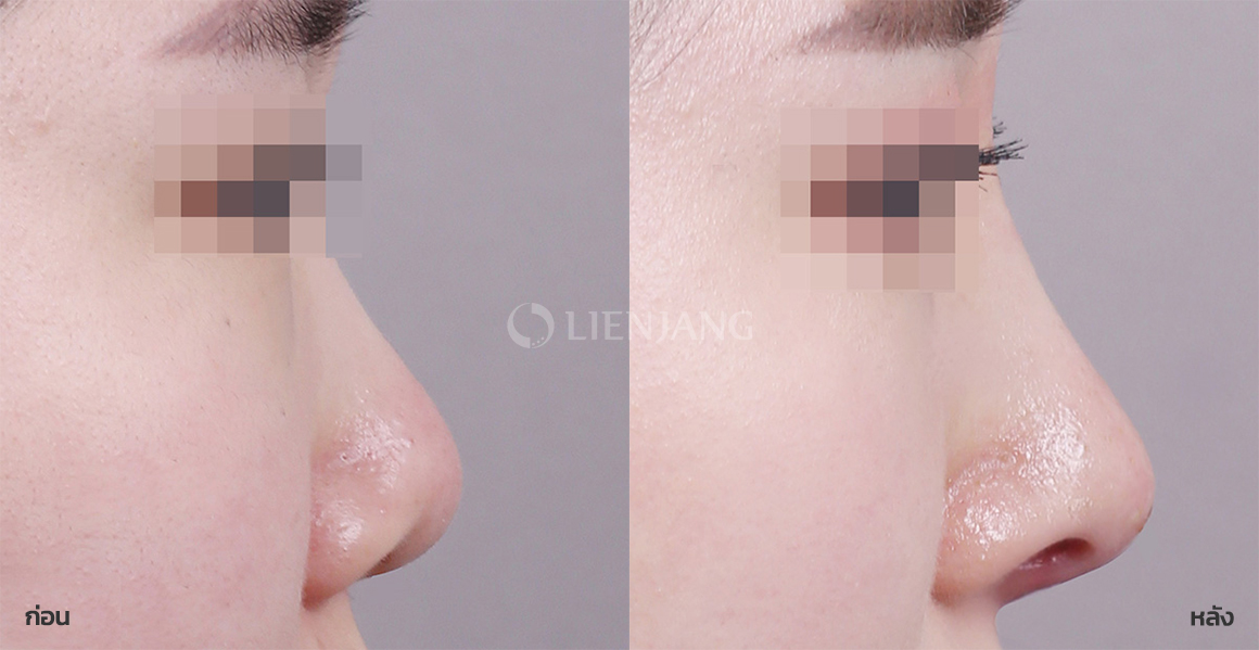Rhinoplasty: bridge + tip · 3 months after surgery — Lienjang case #093
