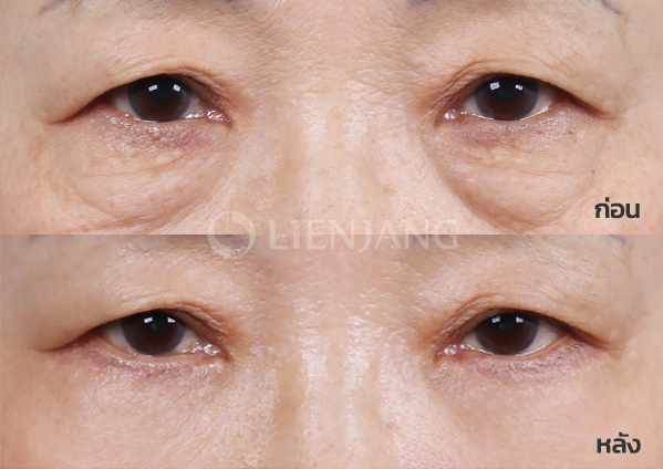 Lower blepharoplasty Plus + Lateral canthopexy · 3 months after surgery — Lienjang case #030