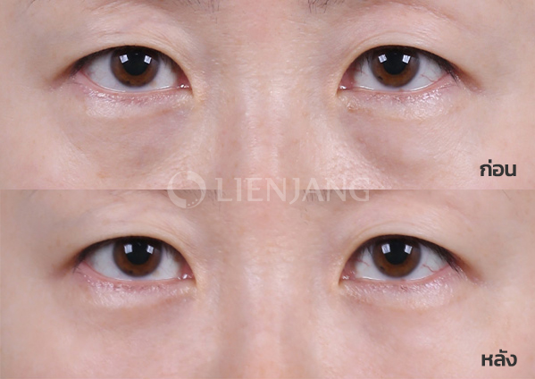Under-eye fat repositioning + Septal reinforcement + 3-STEP technique · 1 month after surgery — Lienjang case #031