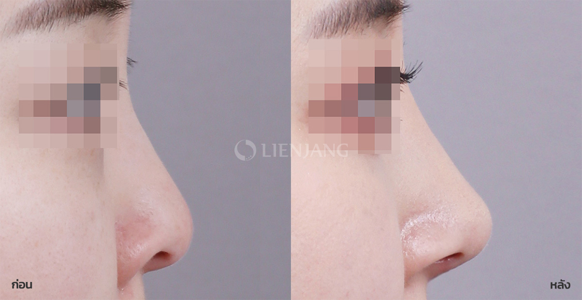 Rhinoplasty: bridge + tip · 6 months after surgery — Lienjang case #094