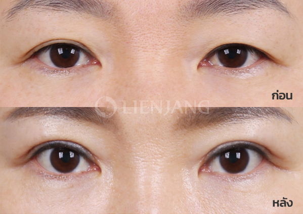 Upper blepharoplasty Plus · 4 months after surgery — Lienjang case #032