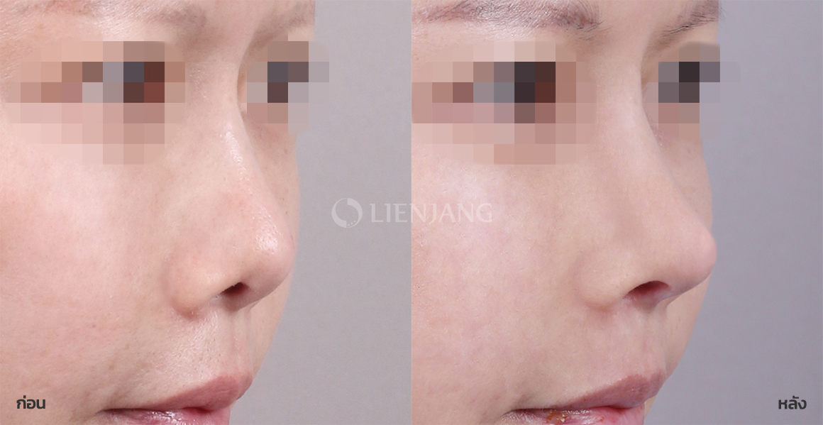 Revision rhinoplasty + Rhinoplasty: bridge + tip · 1 month after surgery — Lienjang case #095