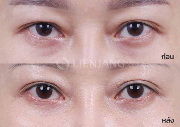 Under-eye fat repositioning · 4 months after surgery — Lienjang case #033