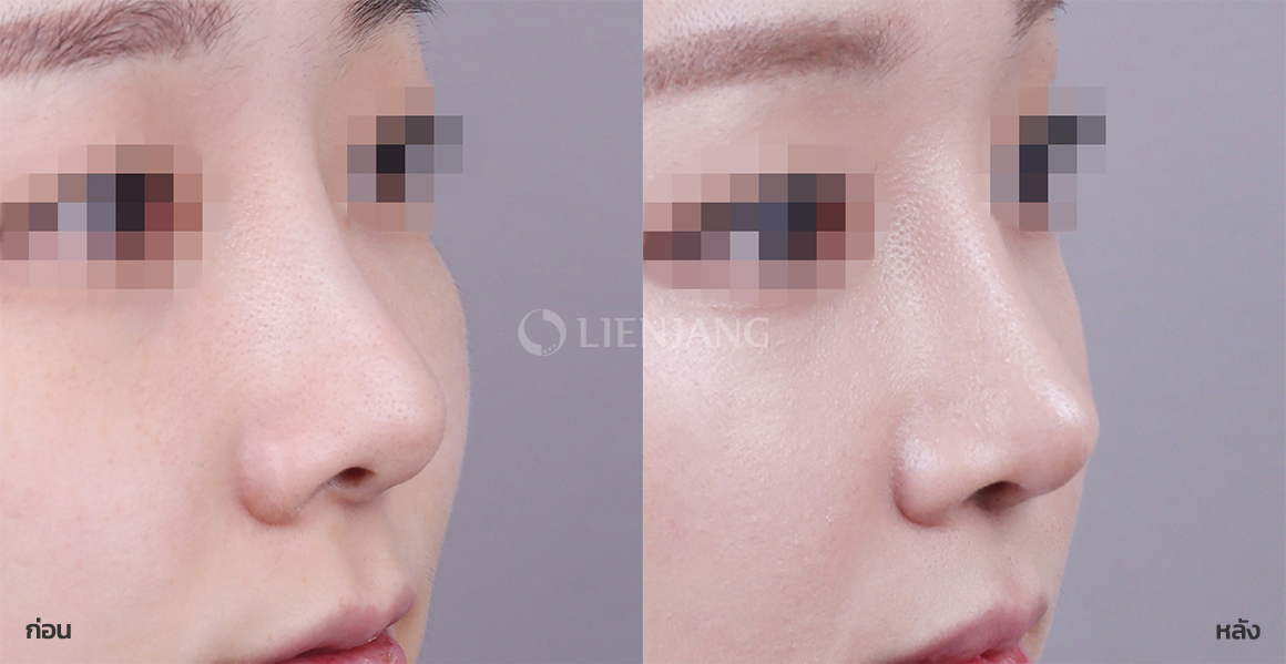 Revision rhinoplasty + Rhinoplasty: bridge + tip · 6 months after surgery — Lienjang case #096