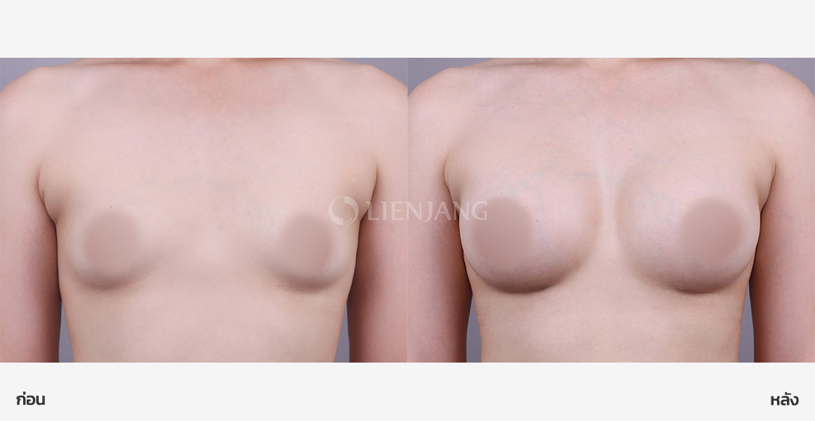 เสริมหน้าอก Sebbin · หลังผ่าตัด 6 เดือน — Lienjang case #127