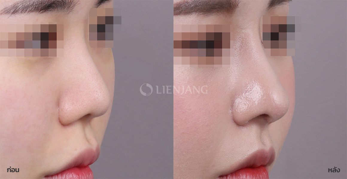Revision rhinoplasty · 1 month after surgery — Lienjang case #097