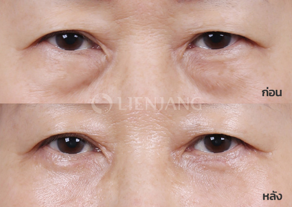 Lower blepharoplasty Plus + Lateral canthopexy · 3 months after surgery — Lienjang case #034