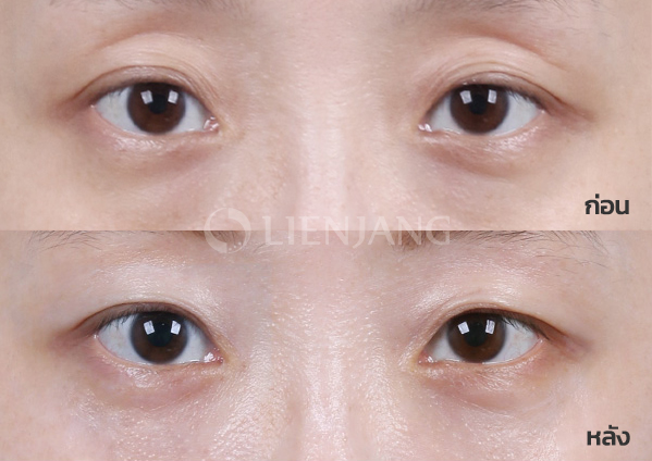 Under-eye fat repositioning · 1 month after surgery — Lienjang case #035