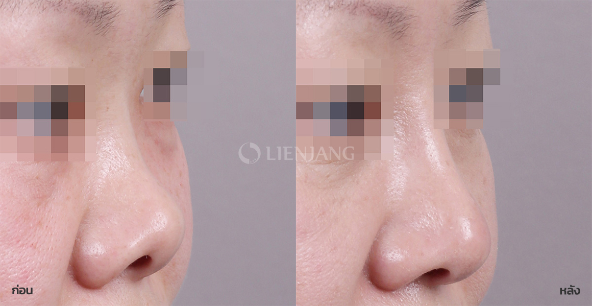 Revision rhinoplasty · 12 months after surgery — Lienjang case #098