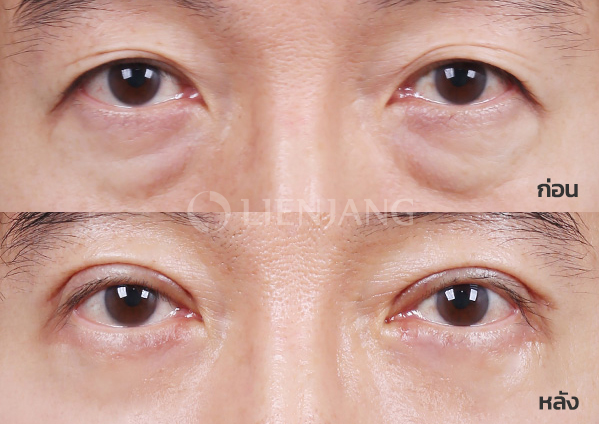 Upper blepharoplasty Plus + Lower blepharoplasty Plus + Lateral canthopexy · 6 months after surgery — Lienjang case #036