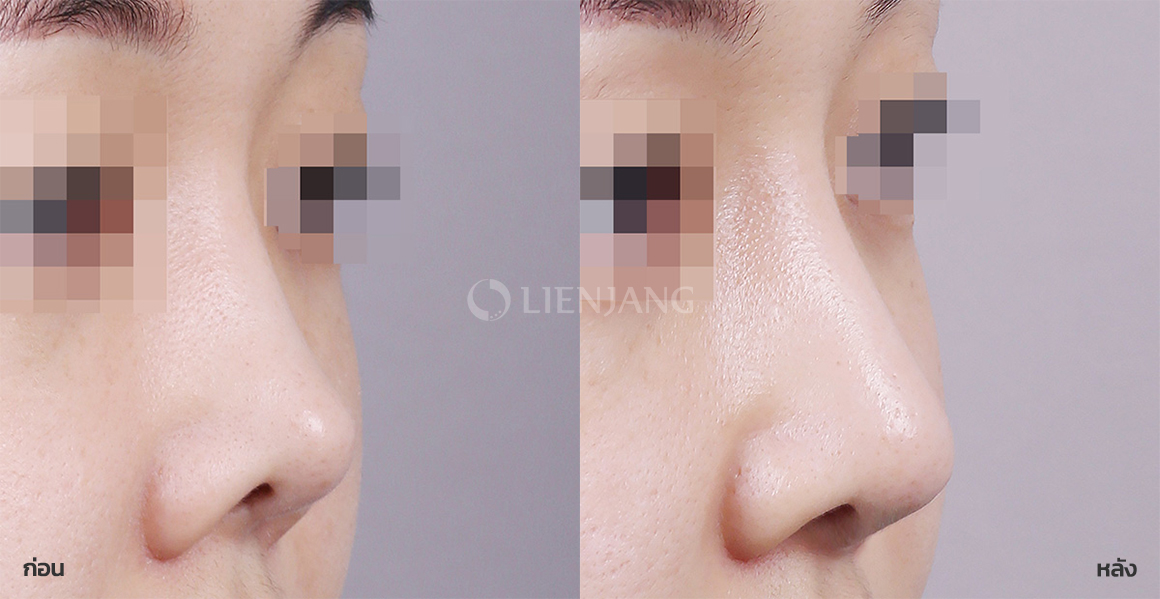 Revision rhinoplasty · 3 months after surgery — Lienjang case #099
