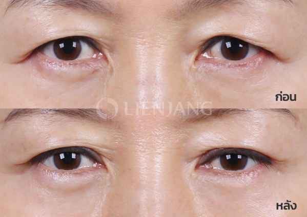 Upper blepharoplasty Plus · 1 month after surgery — Lienjang case #037