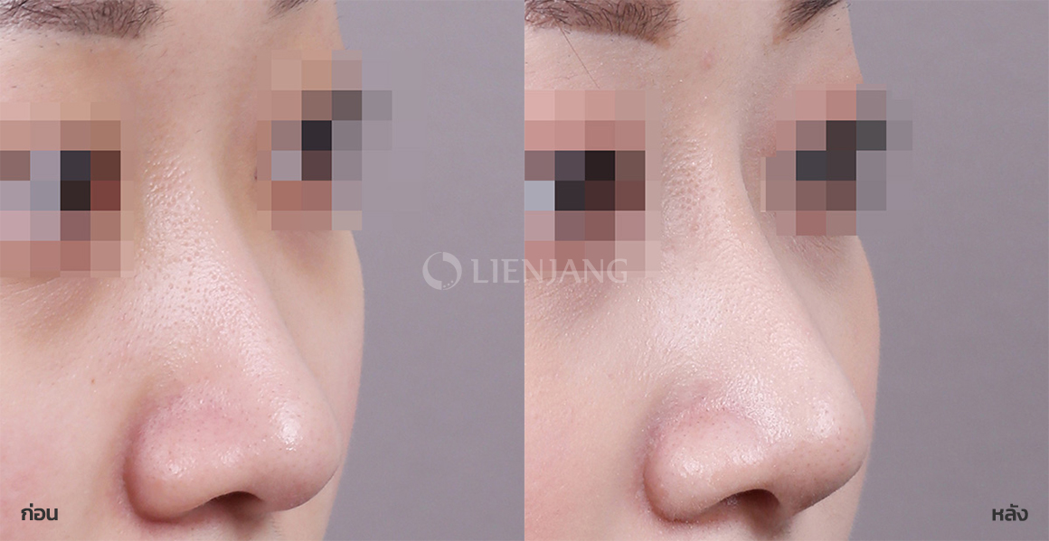 ศัลยกรรมจมูก (งานแก้) · หลังผ่าตัด 6 เดือน — Lienjang case #062