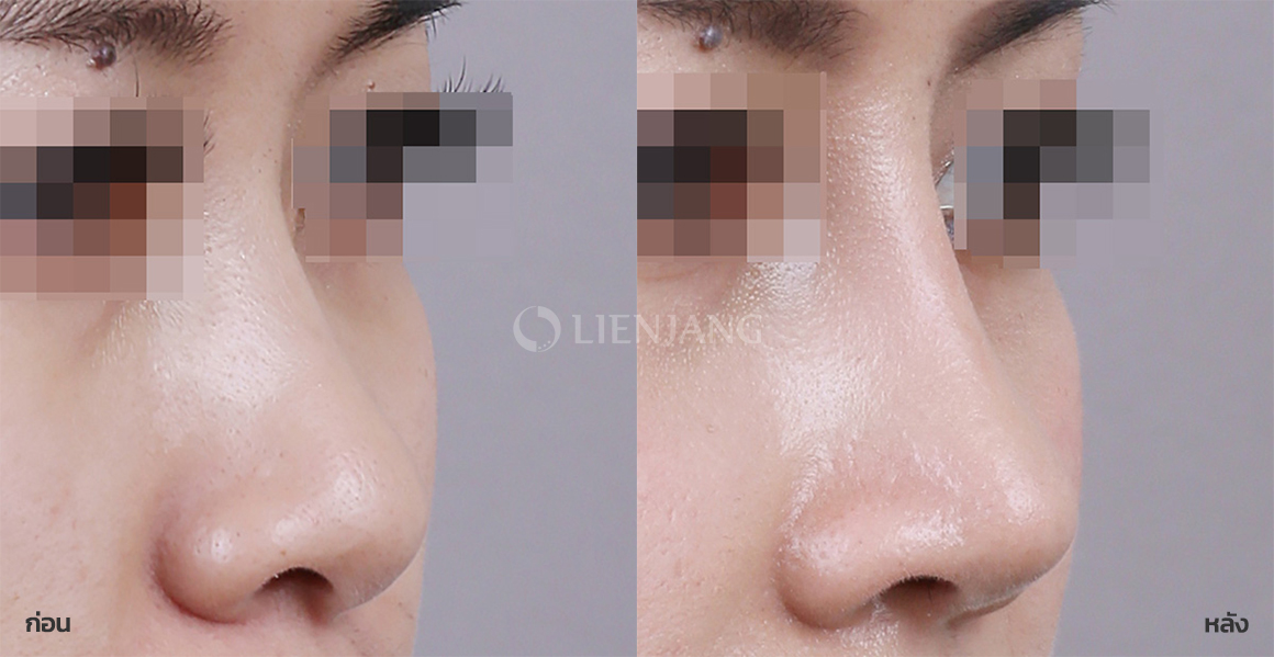 ศัลยกรรมจมูก (งานแก้) · หลังผ่าตัด 6 เดือน — Lienjang case #063