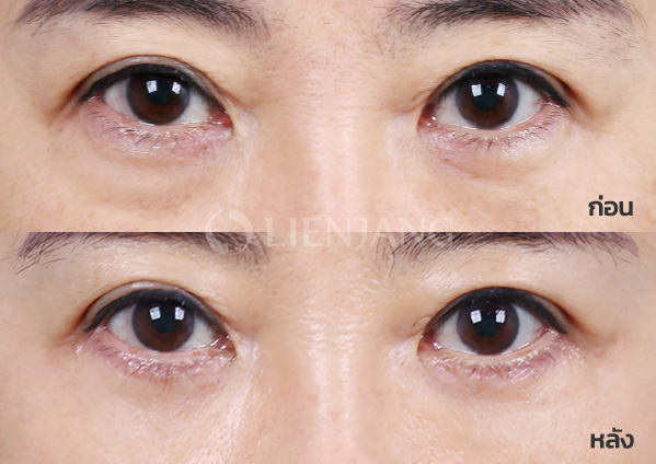 Lower blepharoplasty Plus + Lateral canthopexy · 3 months after surgery — Lienjang case #038