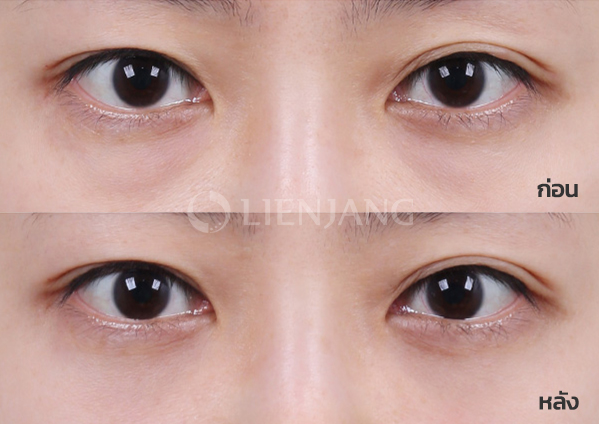 Under-eye fat repositioning + Septal reinforcement · 1 month after surgery — Lienjang case #039