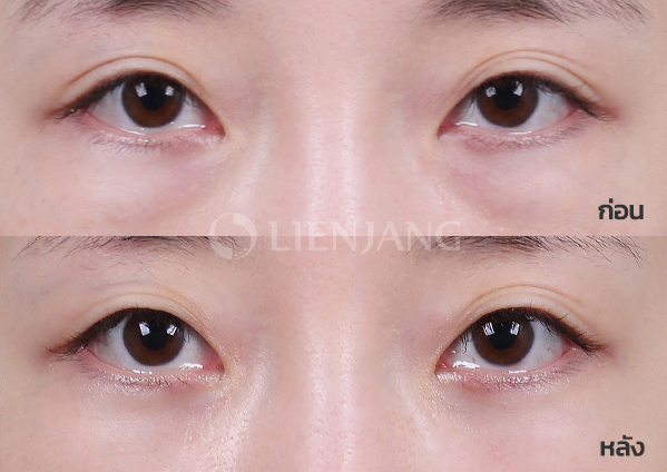 Under-eye fat repositioning + 3-STEP technique · 1 month after surgery — Lienjang case #040
