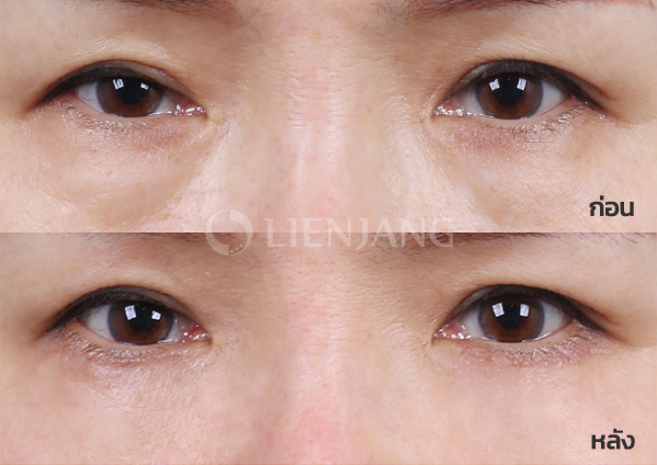 Lower blepharoplasty Plus + Lateral canthopexy · 1 month after surgery — Lienjang case #041