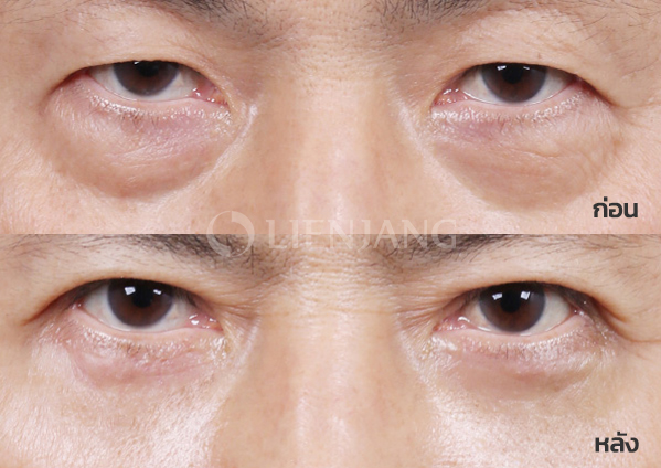 Lower blepharoplasty Plus + Lateral canthopexy · 1 month after surgery — Lienjang case #042
