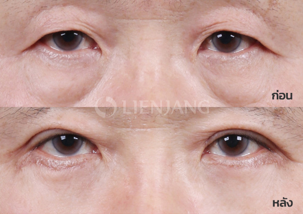 Upper blepharoplasty Plus + Lower blepharoplasty Plus + Lateral canthopexy · 1 month after surgery — Lienjang case #043