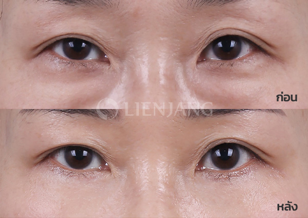 Lower blepharoplasty Plus + Lateral canthopexy · 6 months after surgery — Lienjang case #044