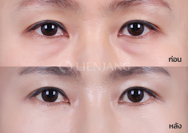 Lower blepharoplasty Plus + Lateral canthopexy · 6 months after surgery — Lienjang case #045