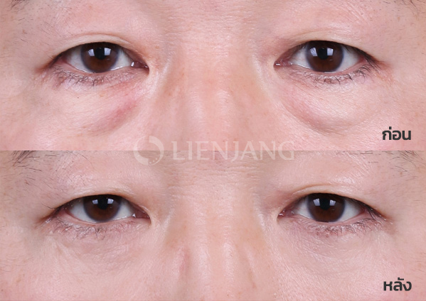 Lower blepharoplasty Plus + Lateral canthopexy · 1 month after surgery — Lienjang case #046