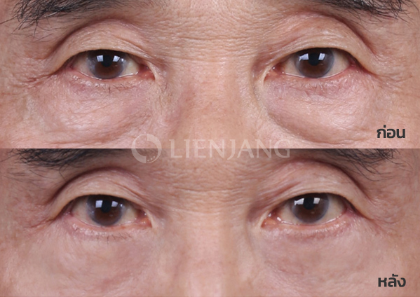 Lower blepharoplasty Plus + Lateral canthopexy · 11 months after surgery — Lienjang case #047