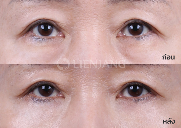 Lower blepharoplasty Plus + Lateral canthopexy · 3 months after surgery — Lienjang case #048