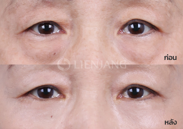 Lower blepharoplasty Plus + Lateral canthopexy · 1 month after surgery — Lienjang case #049
