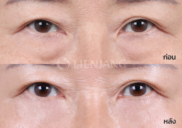 Lower blepharoplasty Plus + Lateral canthopexy · 1 month after surgery — Lienjang case #050
