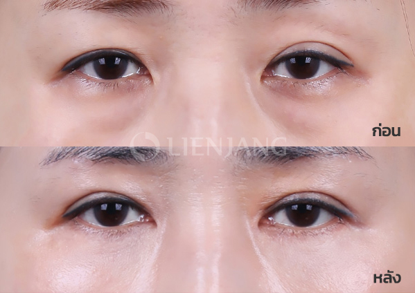 Lower blepharoplasty Plus + Lateral canthopexy + Sub-brow lift + Epicanthoplasty · 3 months after surgery — Lienjang case #051