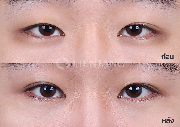 Incisional double eyelid + ptosis correction + Under-eye fat repositioning + Septal reinforcement · 6 months after surgery — Lienjang case #052