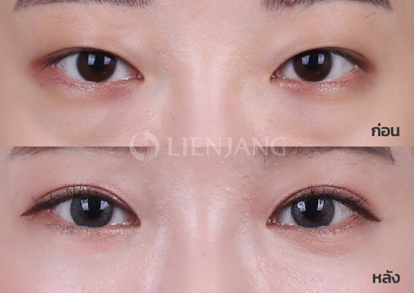 Under-eye fat repositioning + Buried-suture double eyelid + Volume restoration · 6 months after surgery — Lienjang case #053