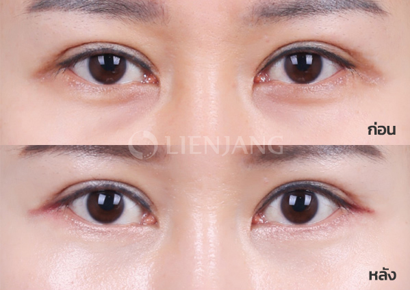 Under-eye fat repositioning + Septal reinforcement · 3 months after surgery — Lienjang case #054