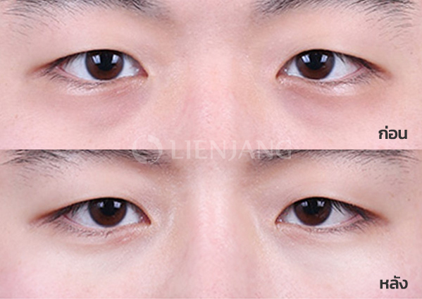 Under-eye fat repositioning + Septal reinforcement · 1 month after surgery — Lienjang case #055