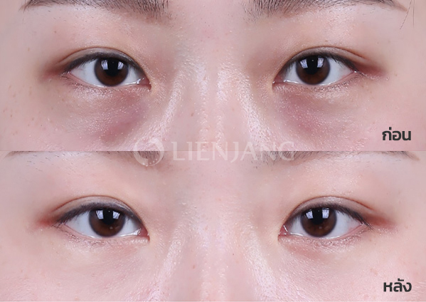 Under-eye fat repositioning + Septal reinforcement · 1 month after surgery — Lienjang case #056