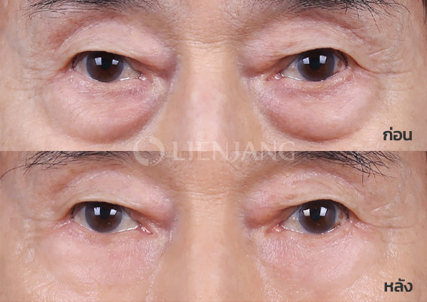 Lower blepharoplasty Plus + Lateral canthopexy · 6 months after surgery — Lienjang case #057