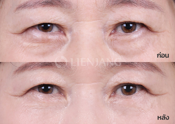 Lower blepharoplasty Plus + Lateral canthopexy · 5 months after surgery — Lienjang case #058