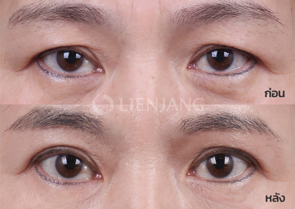 Sub-brow lift · 5 months after surgery — Lienjang case #059