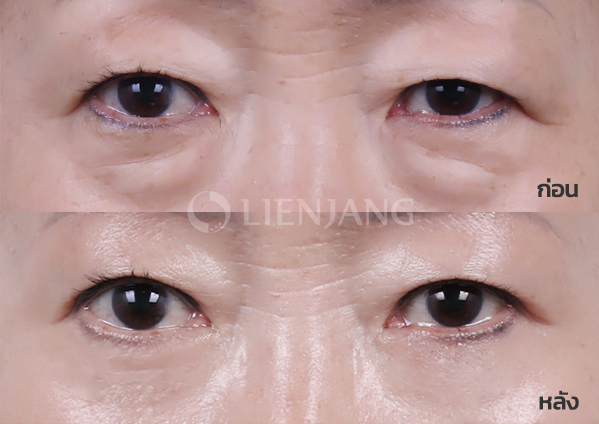 Lower blepharoplasty Plus + Lateral canthopexy + Sub-brow lift · 3 months after surgery — Lienjang case #060