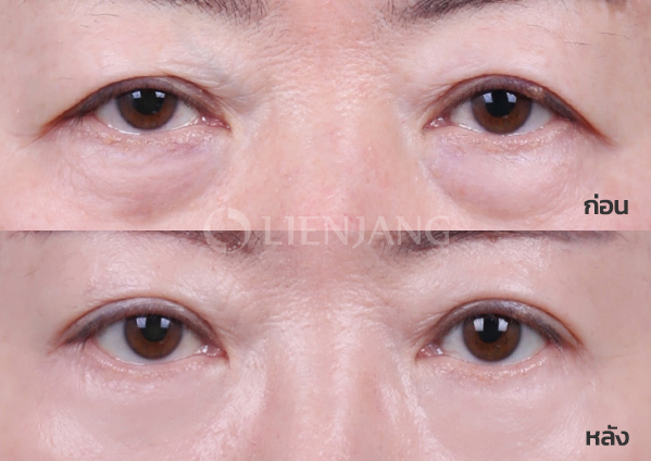 Lower blepharoplasty Plus + Lateral canthopexy + Sub-brow lift · 6 months after surgery — Lienjang case #061